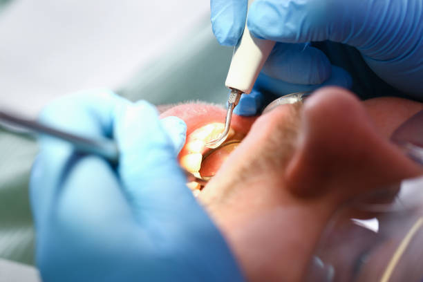 Best Knocked-Out Tooth (Avulsed Tooth) Treatment in Strongsville, OH
