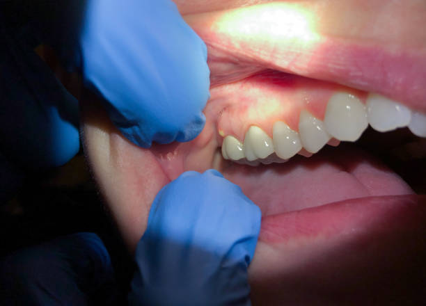 Best Broken or Chipped Tooth Repair in Strongsville, OH